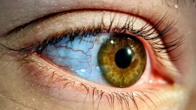 Struggling With Geographic Atrophy? Ask About Izervay.